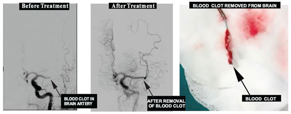 Mechanical Thrombolysis