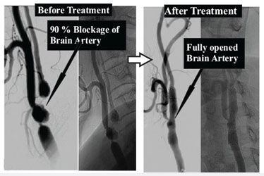 Stenting of Neck Arteries