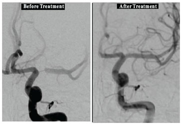 Stenting of Brain Arteries