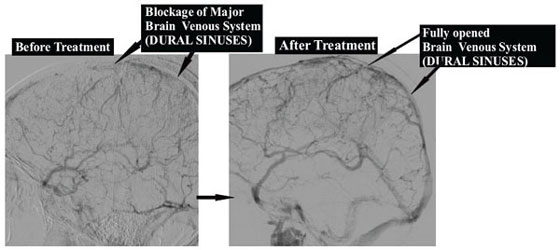 Dural Sinus Thrombolysis