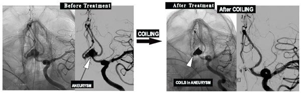 Coiling of Brain Aneurysm