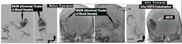 Embolisation of Brain Arteriovenous Malformation, BAVM