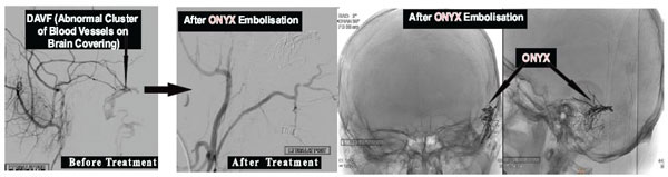 Embolisation of Dural Arteriovenous Fistula, DAVF