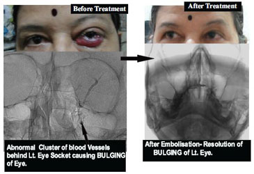 Treatment of Cavernous Dural AVM & CCF