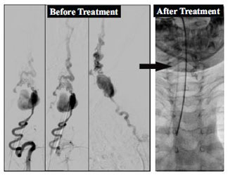 Embolisation of Spine Arteriovenous Malformation,SCAVM