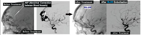 Embolisation of Brain Arteriovenous Fistula, AVF